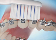 Perfect Smile ortho Brushing steps